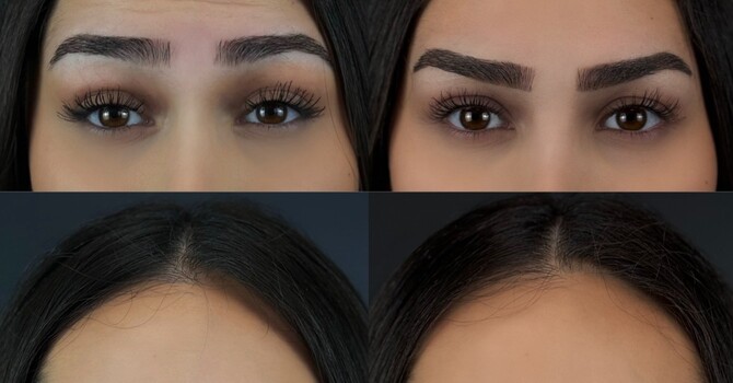 The Benefits of Botox: Why It's More Than Just a Wrinkle Treatment image