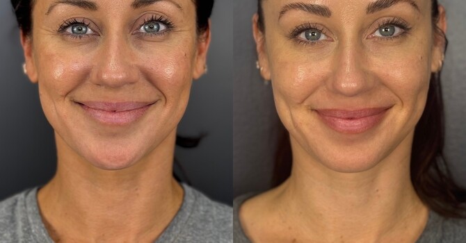 Best Botox in Orange County – Why Masters Medspa Is the Top Choice image