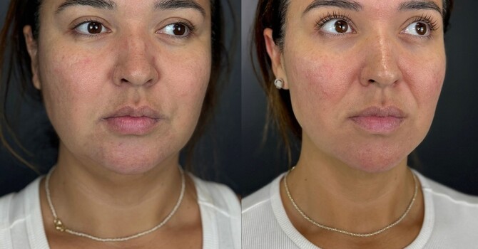 Best Laser Treatments in Orange County – Why Masters Medspa Is the Trusted Choice