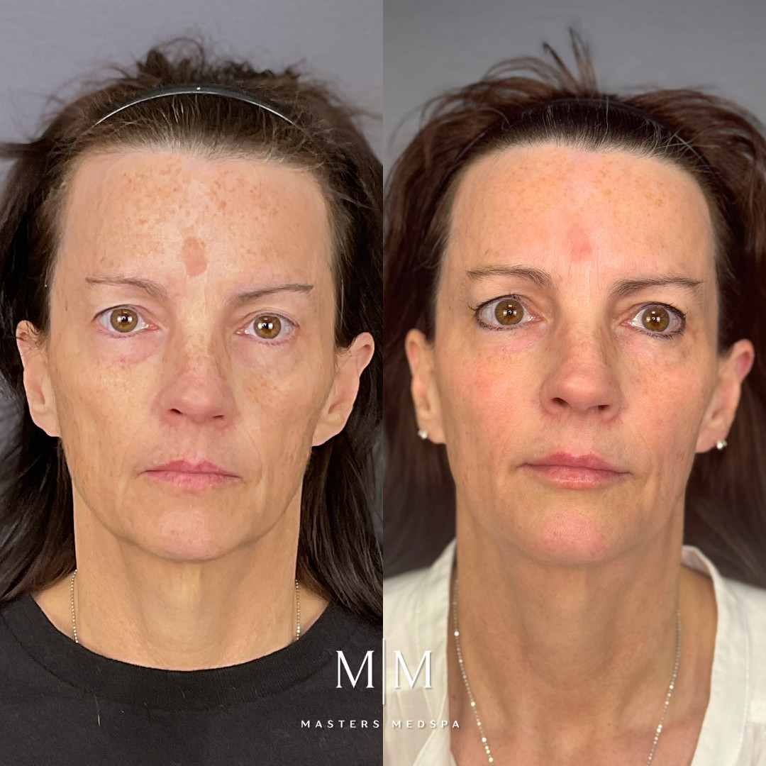 MM_B&A_UltraClear&Injectables_ByTannaz&Allison_3