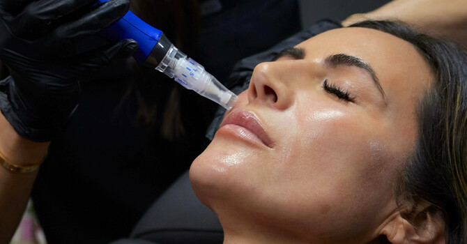 Microneedling