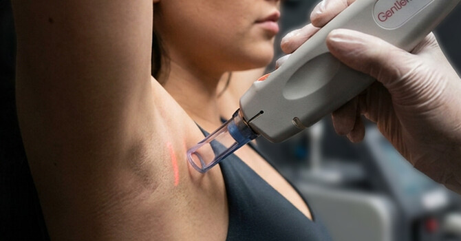 Laser Hair Removal